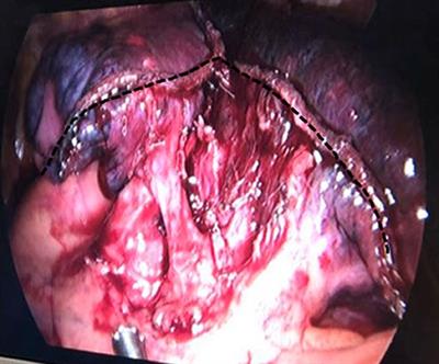 “Non-Triangle Plane” Surgical Technique of Video-Assisted Thoracic Surgery Atypical Segmentectomy for Stage IA Non-Small-Cell Lung Cancer: Early Experience